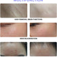 Intense Pulsed Light